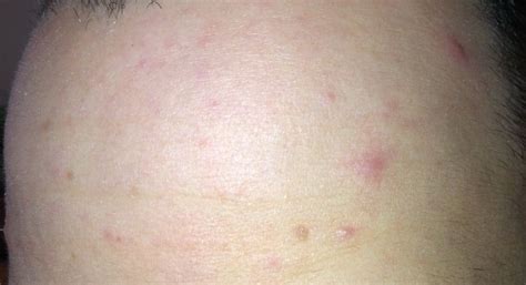Persistent Forehead Only Acnefolliculitis Pics General Acne