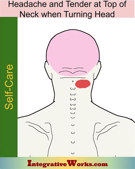 Self Care Headache And Tender At Top Of Neck When Turning Head Self