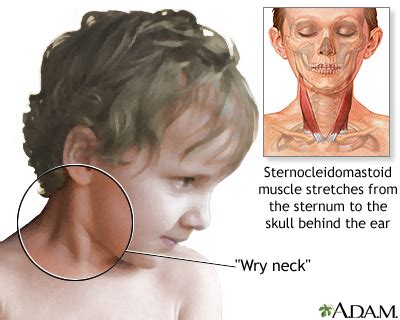 Torticollis Wry Neck MedlinePlus Medical Encyclopedia Image