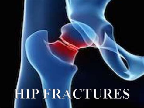 Clinical Signs Of Hip Fracture