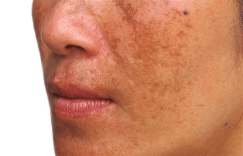 Melasma And Hyperpigmentation What Can You Do About It M Aesthetic
