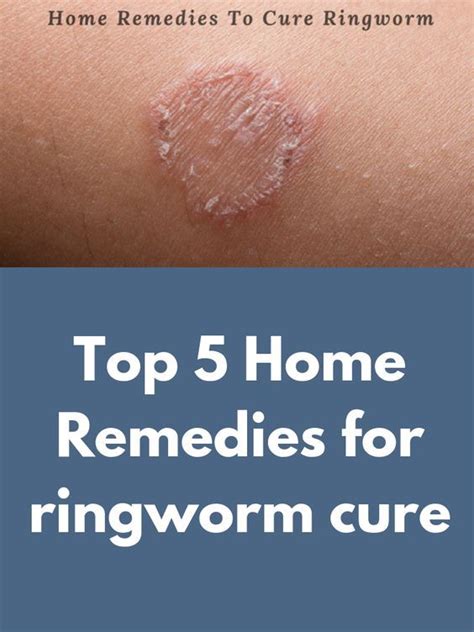 Top 5 Home Remedies For Ringworm Cure Ringworms Are A Common Infection