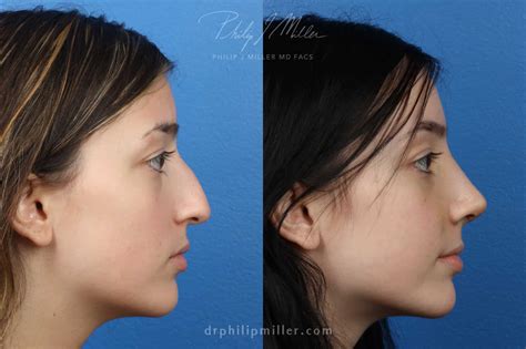 What Rhinoplasty Cost To Expect In New York A Full Guide