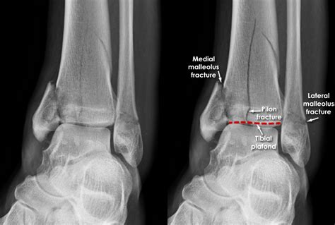 Trauma X Ray Lower Limb Gallery 2 Ankle Other Injuries
