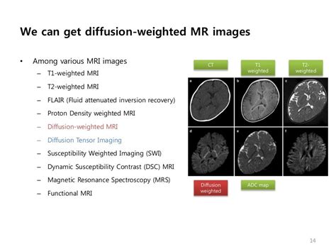 Diffusion Weighted Mri