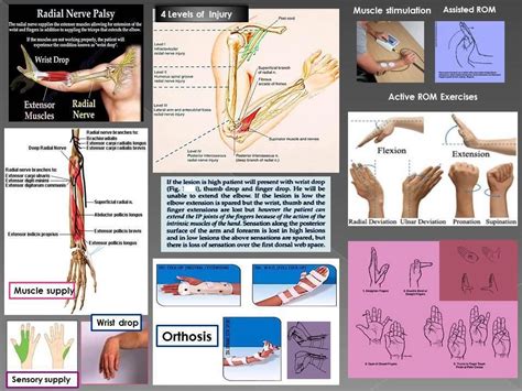 Radial Nerve Palsy Exercise Nerve Palsy Radial Nerve Ulnar Nerve