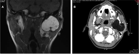 Frontiers Large Parotid Gland Lipoblastoma In A Teenager