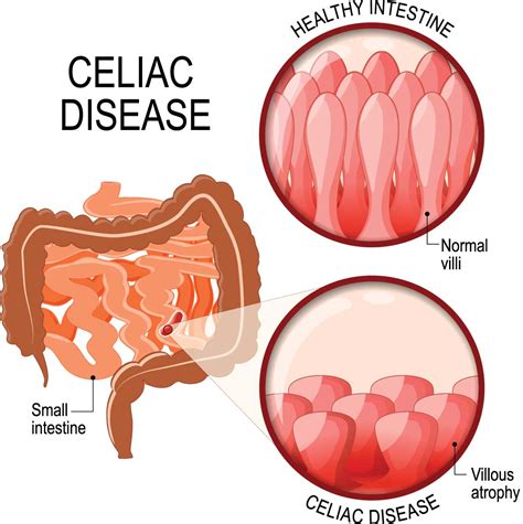 Celiac Disease Northern Virginia Gastroenterology