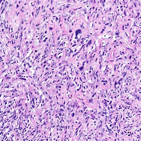 Pathology Outlines Sarcomatoid Carcinoma
