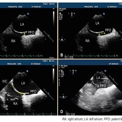 Characteristics Of The Patent Foramen Ovale Pfo A Pfo Width B