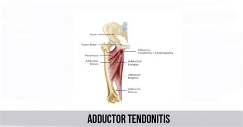 Adductor Tendonitis World Wide Lifestyles Weight Loss And Gain Tips