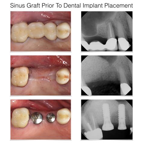 Sinus Bone Grafting And Dental Implant Placement Philadelphia Pa Laudenbach Periodontics