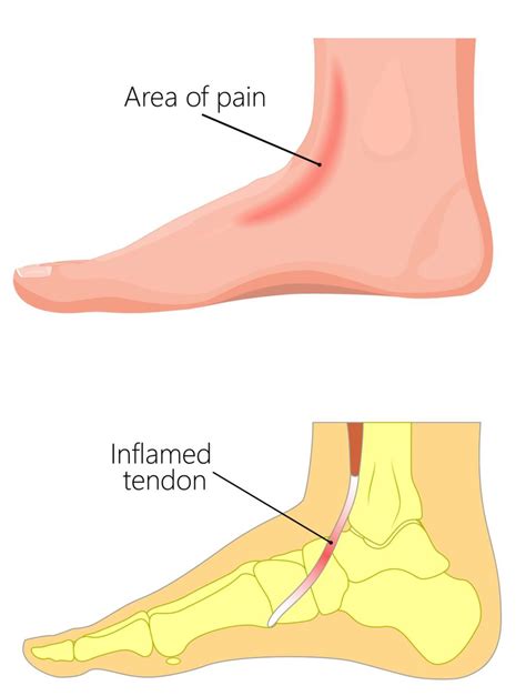 Pain Across The Top Of The Foot Causes Symptoms And Best Treatment