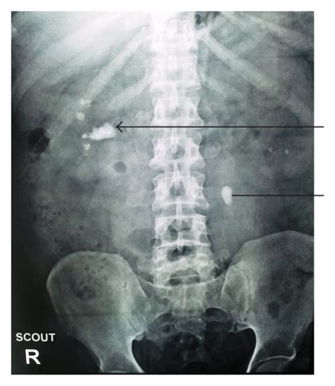 Plain X Ray Kub Showing Right Renal Pelvic Calculus With The Stainless