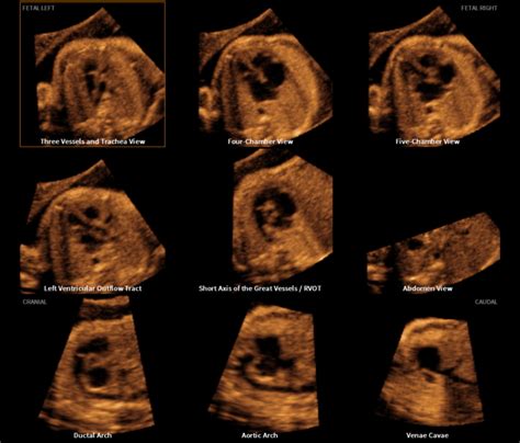 Samsungs Ultrasound Technology For Fetal Echocardiography Selected As