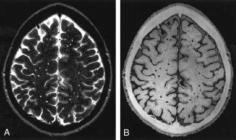 Sandlike Appearance Of Virchow Robin Spaces In Early Multiple Sclerosis