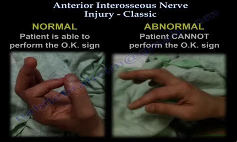 Anterior Interosseous Nerve Injury Classic Everything You Need To Know