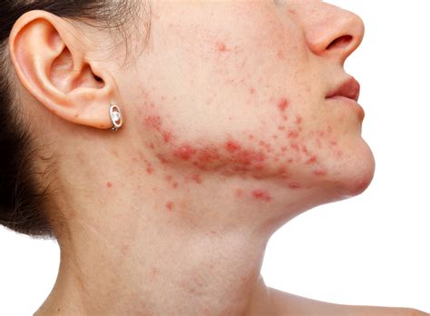 Young Girl With Skin Problem Cosmetics And You Acne Treatment