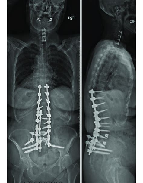 Posteroanterior And Lateral Radiographs Obtained To Assess Scoliosis