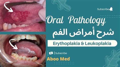 Erythroplakia And Leukoplakia 1 Pathology And Systemic Diseases Related To Oral Pathology شرح أمراض