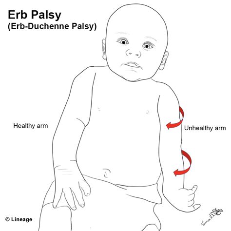 Erb Duchenne Palsy Usmle Strike