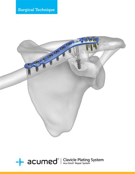 Acumed Clavicle Plating System With Acu