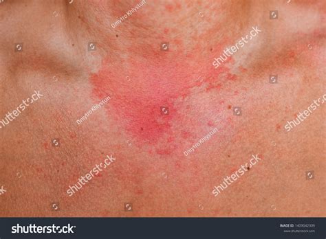 Allergic Skin Reaction On Man Neck Stock Photo 1409042309 Shutterstock
