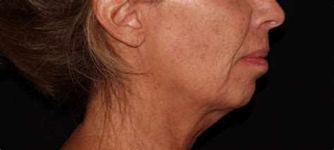 Botox In Lower Face Before And After Photos Rejuva Center