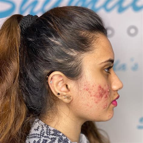 Acne Treatment In London Acne Treatment Options Shumailas