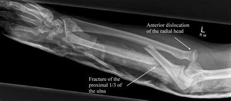Monteggia Fracture Subluxation Of Radial Head Proximal Ulnar