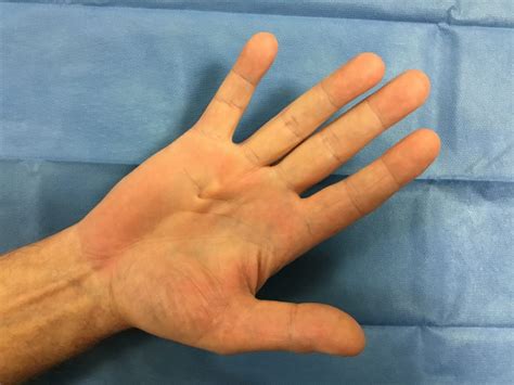 Dupuytrens Disease Mary Obrien Plastic And Hand Surgery