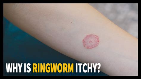 All You Need To Know About Ringworm Why Is It Itchy Youtube