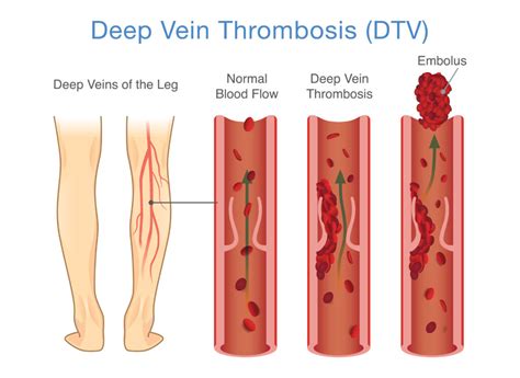 Deep Vein Thrombosis What Is It And How Can You Avoid It