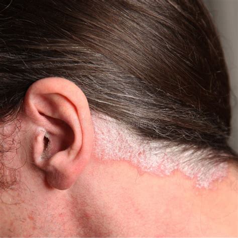 Psoriasis In The Ear And Neck Stock Image Image Of Finger Relief