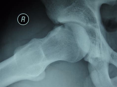 Femoroacetabular Impingement Fai Dominic Carreira Md Hip