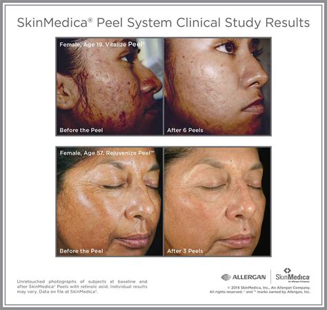 Chemical Peel Goldson Medical