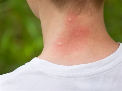 Why Do Some People Get Bitten By Mosquitoes More Than Others Kays
