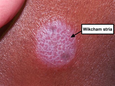 lichen planus causes what it looks like and how to get rid of it