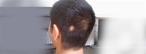 What Causes Hairless Spots On The Scalp Hair Transplant Dubai