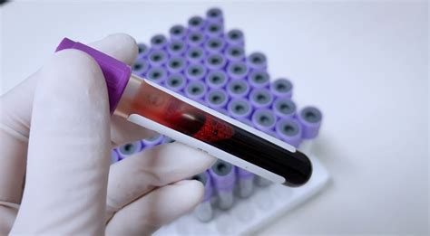 Hemograma Completo O Que Voc Precisa Saber Sobre O Exame De Sangue Cerpe