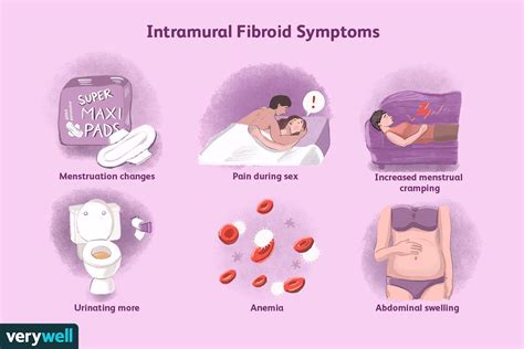 Intramural Fibroids Causes Symptoms And Treatment