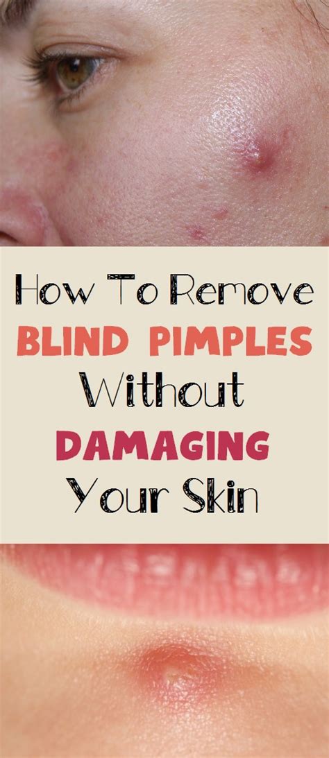 How To Remove Blind Pimples Without Damaging Your Skin How To Beauty