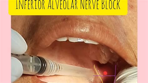 Inferior Alveolar Nerve Block Is Easy Youtube