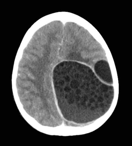 Intracranial Recurrent Hydatid Cysts With Secondary Infection Eurorad