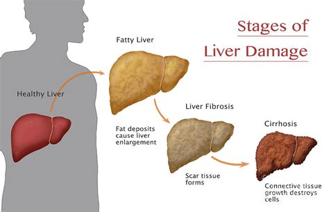 Liver Cirrhosis Stages