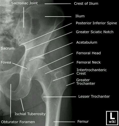 Pelvis Anterior Posterior X Ray Radiology