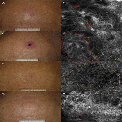 Figure Basal Cell Carcinoma Of Left Forehead A Baseline Clinical