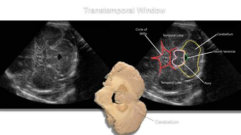 Neonatal Neurosonography Sonographic Tendencies