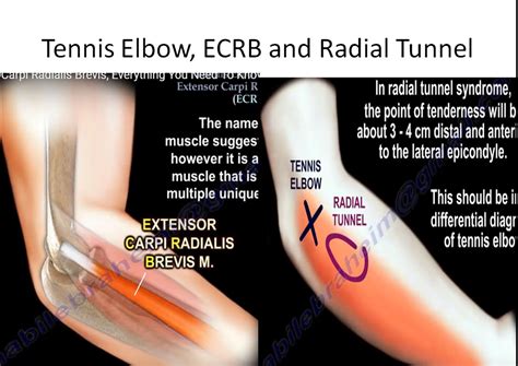 Tennis Elbow Ecrb And Radial Tunnel Syndrome —