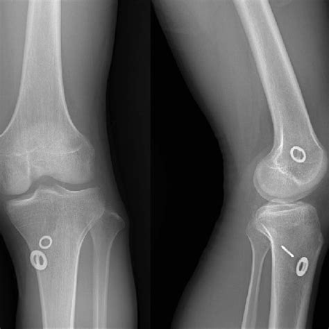Postoperative Anteroposterior And Lateral Radiographs Of Knee